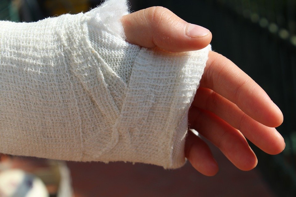 Hand Cast Fractured after an Accident Stock Photo - Image of hand